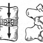 Degenerative changes in tissue between the vertebrae of a dog