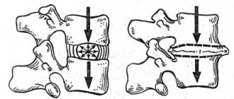 Degenerative changes in tissue between the vertebrae of a dog